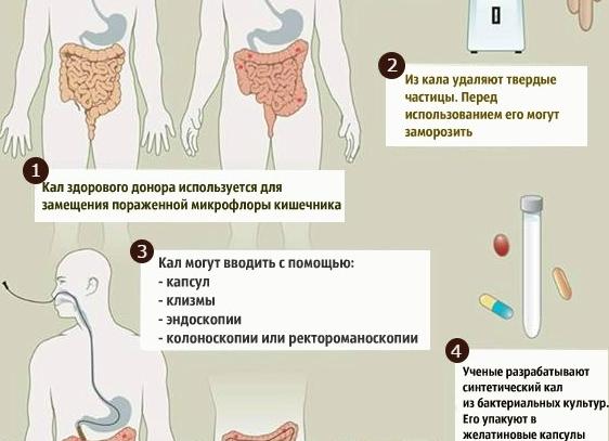 Что такое пересадка кала