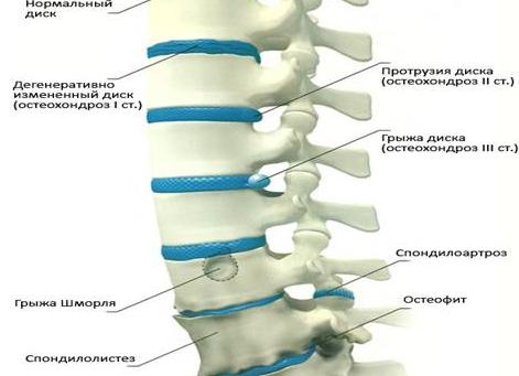 Что такое остеохондроз и как его лечить