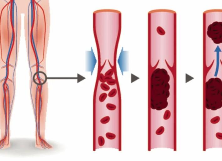 Тромбоз: что это такое и как предотвратить  Здоровье