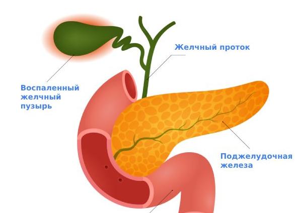 Холецистит: что это такое и как лечить  Здоровье