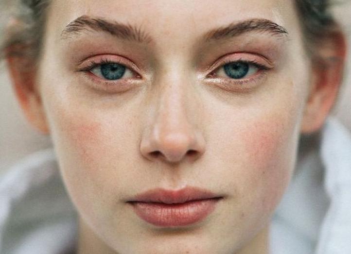 Личный опыт: как я вылечила прыщи